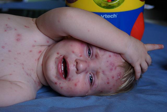 Recent Chickenpox Chickenpox – Learn the Risk