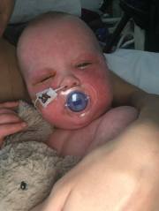 Alba Moss Measles April 2019_4